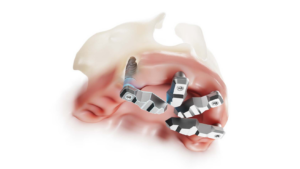 DirectIP Implantat Kiefer